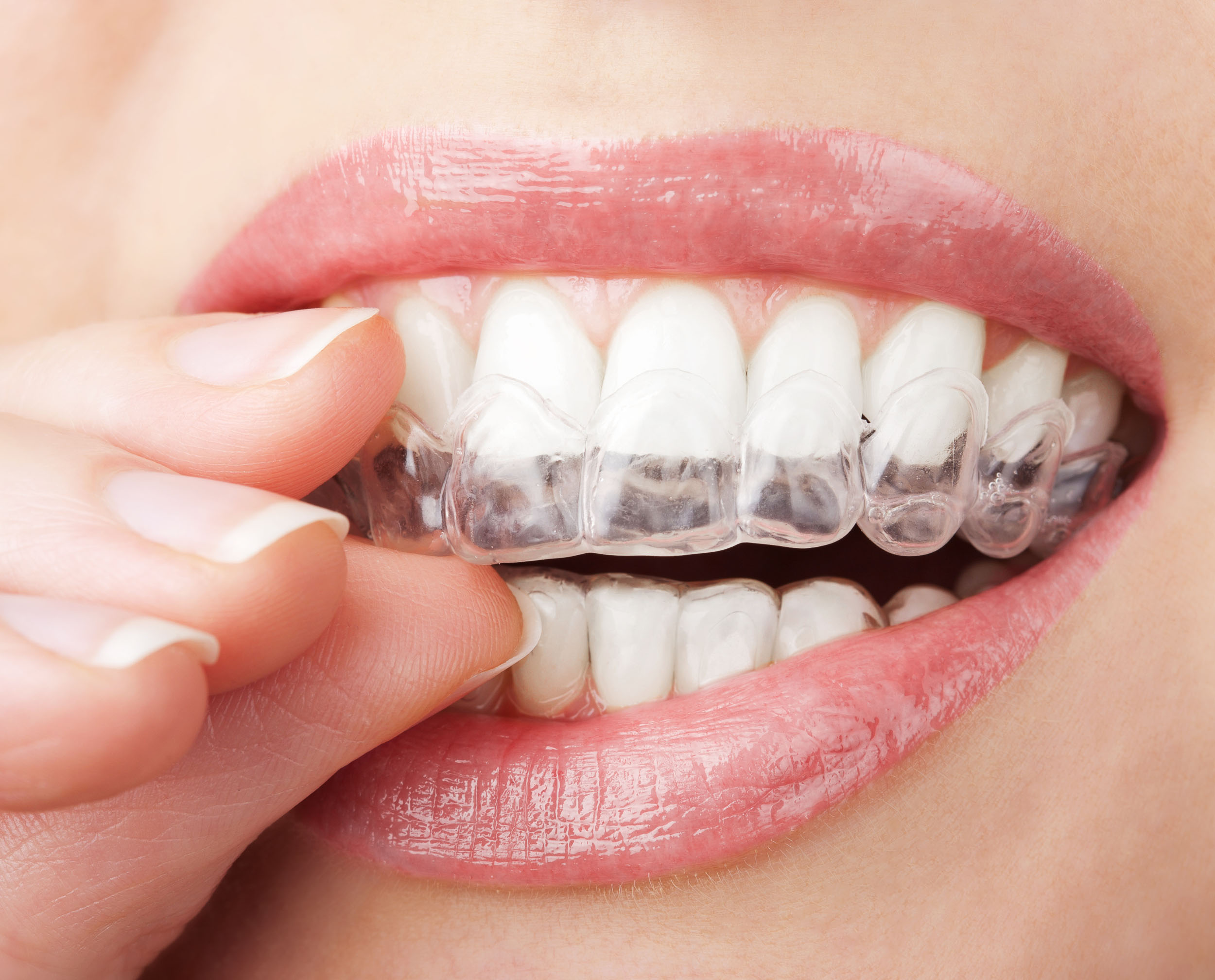 clear aligners invisalign nivellipso at smiletowin.com